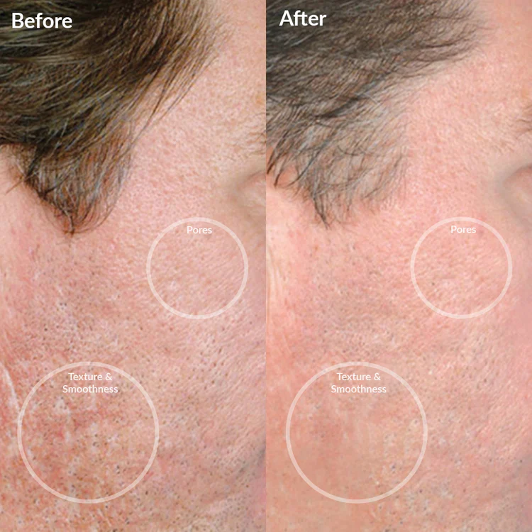 PMD Personal Microderm Pro - Black - Image 4